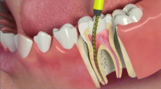 Penyakit Pulpa: Langkah-langkah untuk Menyelamatkan Gigi Anda