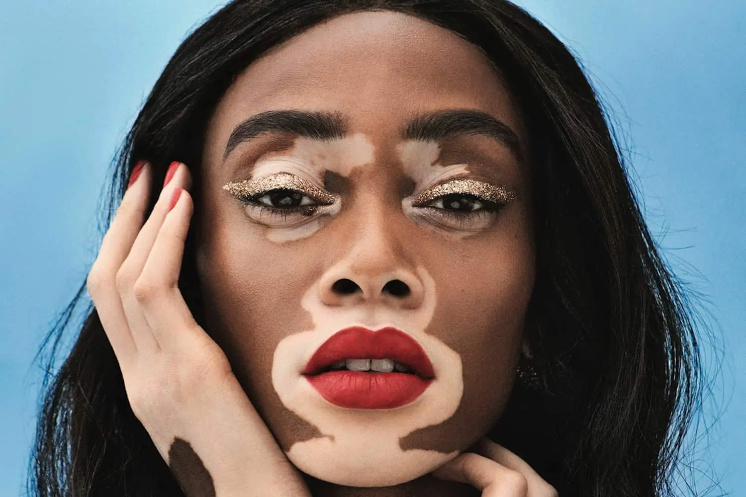Winnie Harlow: Championing Vitiligo Awareness and Redefining Beauty Standards