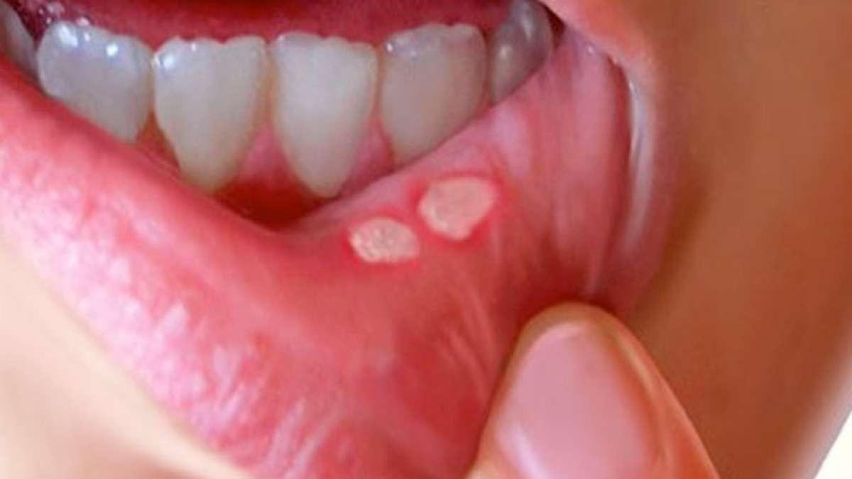 Penyebab Sariawan: Dari Stres Sampai Kekurangan Vitamin, Ini yang Perlu Kamu Tahu