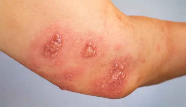 Tingkat Nyeri yang Mengganggu Aktivitas